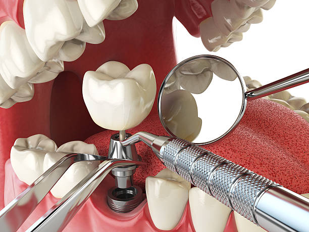 Best Emergency Tooth Extraction in Walnut Cove, NC